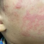 疫苗接种率降低 专家忧虑麻疹可能大面积传播