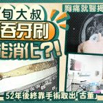 生吞牙刷|64岁大叔儿时误以为能消化 绞痛靠手术取52年“古董”