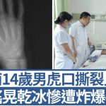 湖南14岁男摇晃干冰惨遭炸爆手 虎口撕裂10cm直见白骨