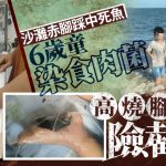 食肉菌︱厦门6岁男童沙滩赤脚踩死鱼 高烧昏迷入ICU险截肢
