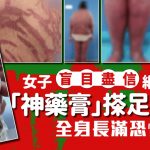 止痒神药?女子盲涂网红药膏10年 全身长满恐怖蛇纹