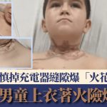 睡覺翻身頸鏈卡充電器縫隙 美8歲男童觸電燒傷須植皮 醫生:慢一步恐喪命