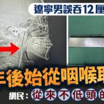 辽宁大叔误吞12cm筷子8年后始取出 网民:从来不低头