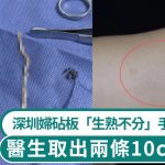 砧板“生熟不分”|爱食田鸡深圳妇手臂剧痛 “鹌鹑蛋”肿块藏两条10cm活虫