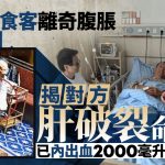 肝破裂︱杭州店长见不适食客一异样 坚持送院原来内出血已2公升