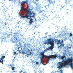 美國寄生蟲疫情逾1251人感染 衛生署:未擴散至加拿大