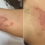 发烧变冻伤︱浙江女用干冰助六旬父退烧反致一身水泡红肿 医生:如烧红焫鸡贴皮肤