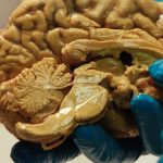 人类大脑竟是“两个器官” 惊人研究或有助渐冻人症治疗