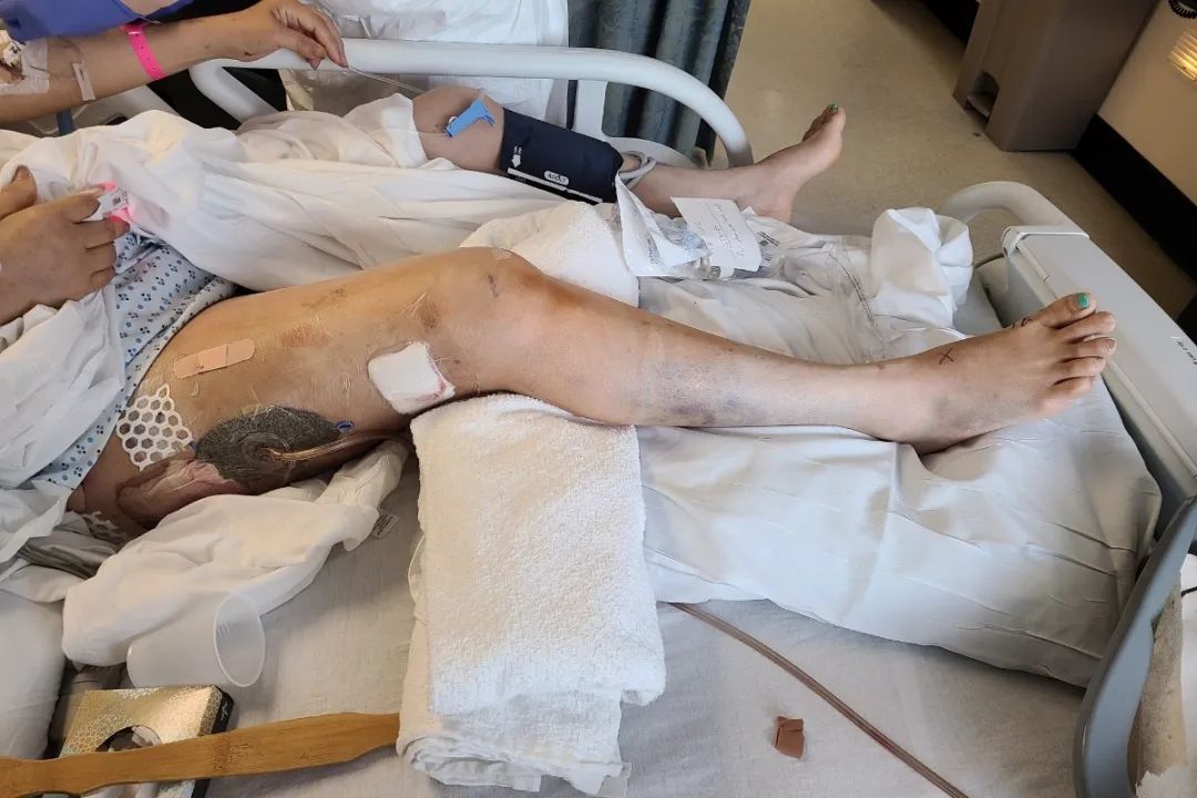 愤怒! 华人一家遭暴徒疯狂洗劫  仓皇逃命中被铁锹、砖头暴打 进ICU抢救!