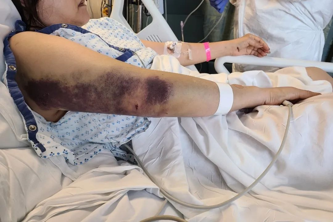 愤怒! 华人一家遭暴徒疯狂洗劫  仓皇逃命中被铁锹、砖头暴打 进ICU抢救!