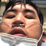 华裔青年离奇染新冠 竟然失去3周记忆