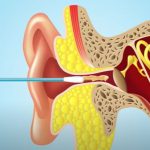 还在用棉签掏耳朵?快别用了,专业医生给出忠告!