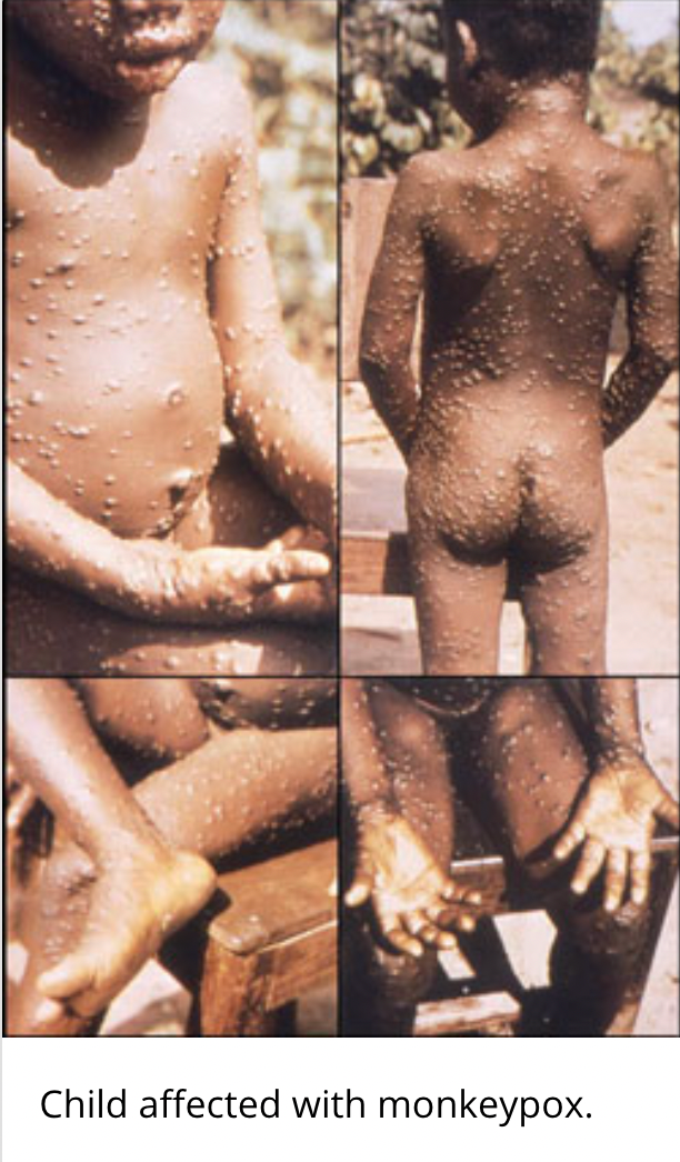 美国200多人接触患猴痘病毒男子 有感染风险！图片慎入